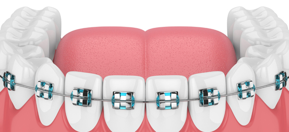 Why Might Six Month Braces® Be Needed