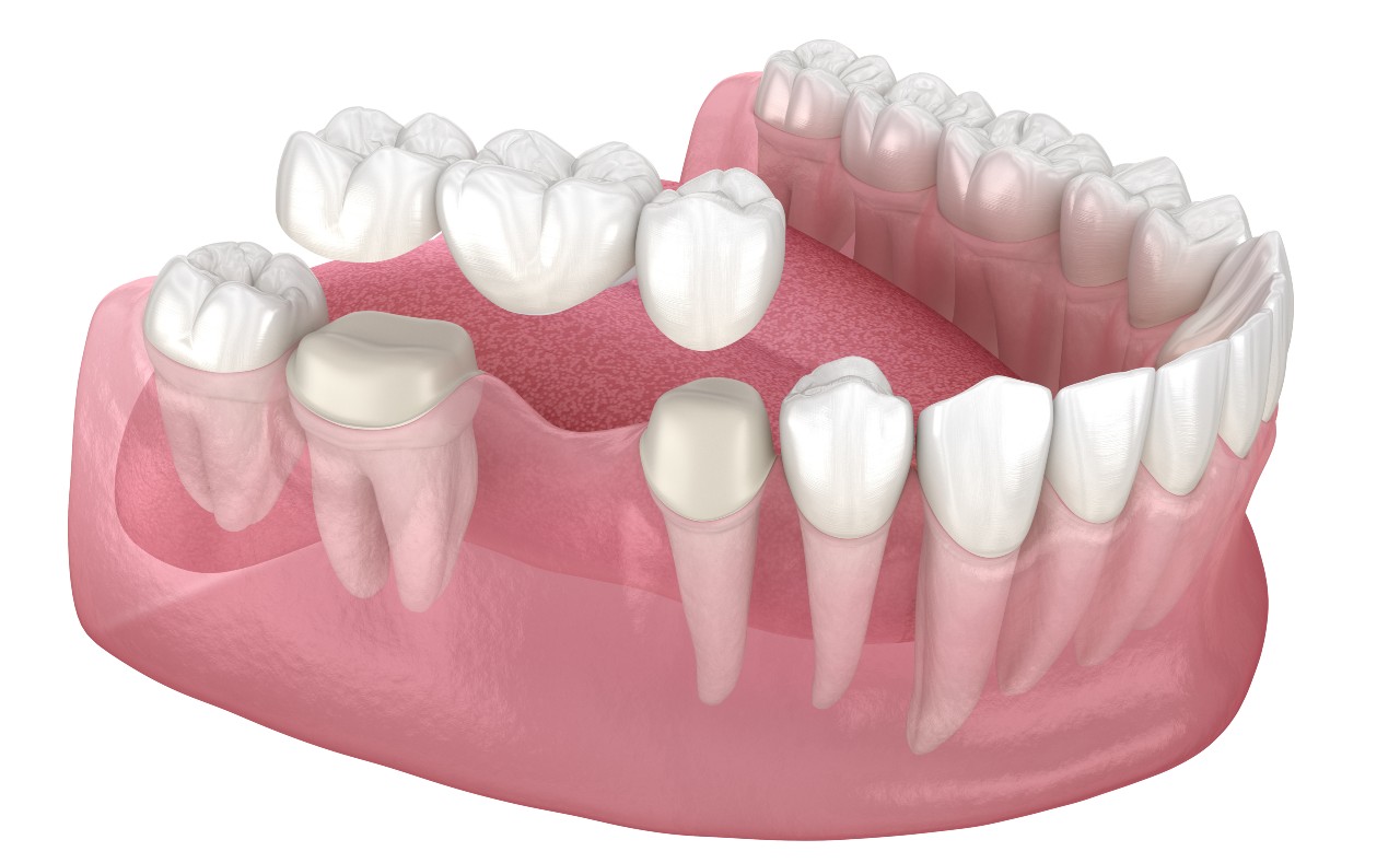 Are Dental Bridges Painful?